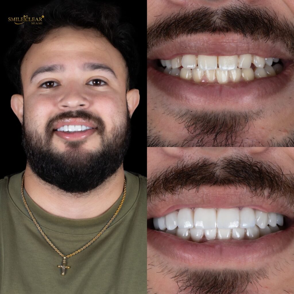 Porcelain Smile Design